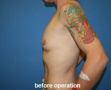 plastic-surgery-breast-augmentation